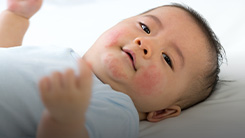 Early Feeding, Atopic Disease, Short Bowel Syndrome