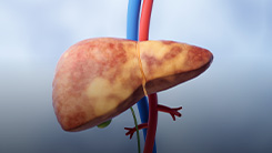 FIND Trial: Prebiotics for Pediatric Fatty Liver Disease