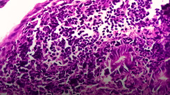 PediCRaFT: FMT in Pediatric Crohn’s Disease