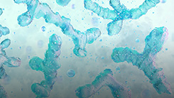 FMT Trials in Anorexia Nervosa and SIBO