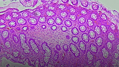 PediFETCh: FMT in Pediatric Ulcerative Colitis