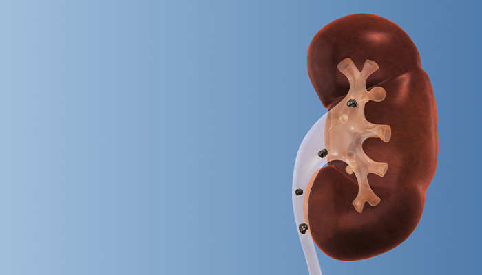 Results from the PKIDS Network contributed to one of the largest studies for the surgical management of kidney stones patient outcomes of three approaches