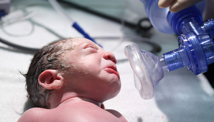 Supraglottic Airway Use During Neonatal Resuscitation