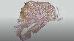 Tumor Microenvironment